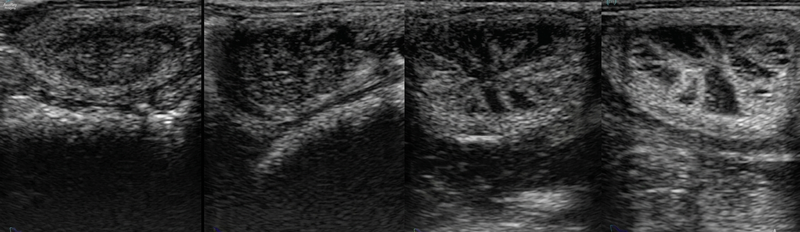 Graus de edema uterino
